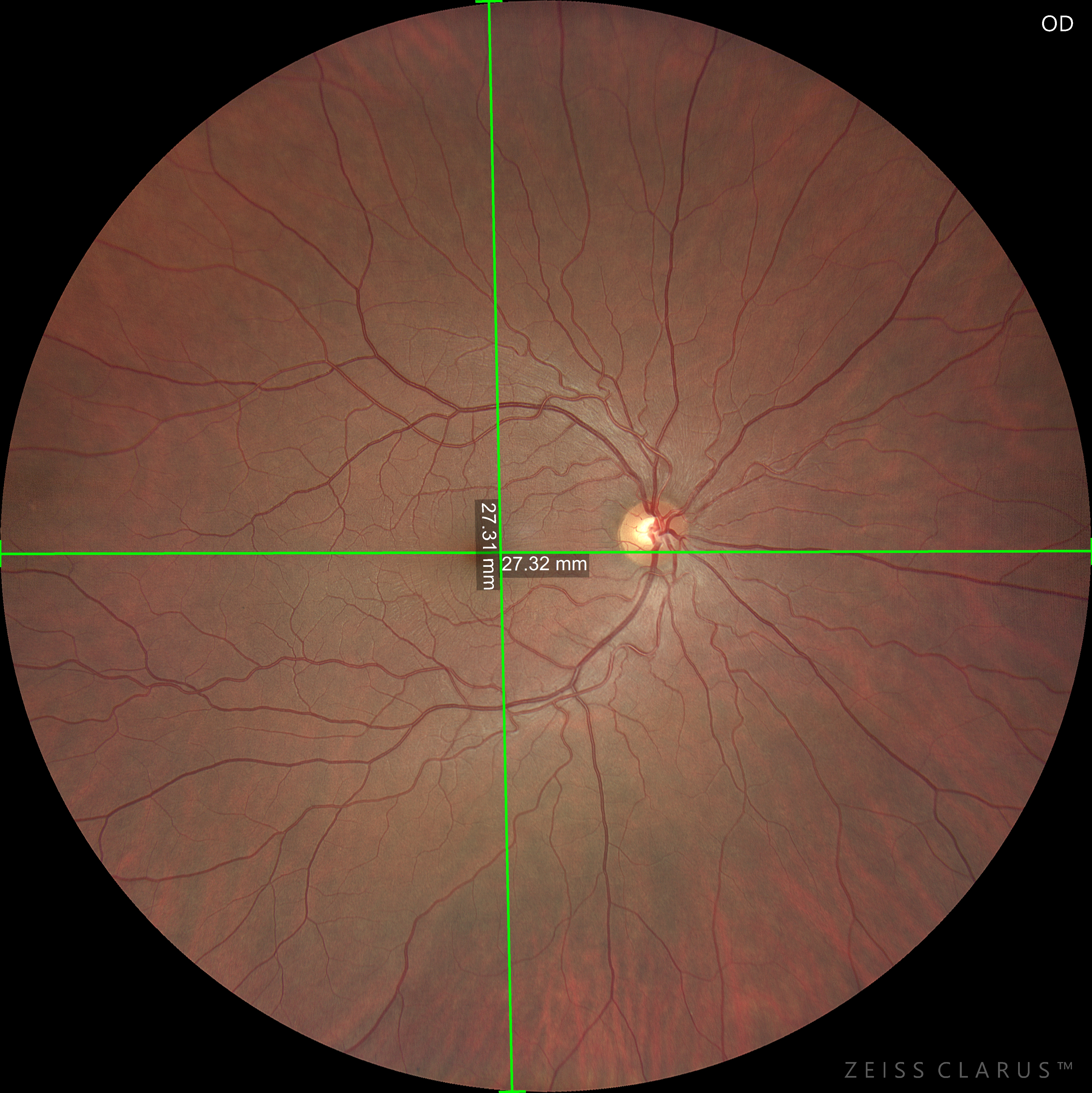 Imaging  retinico con Clarus 500 Zeiss da uno shoh
